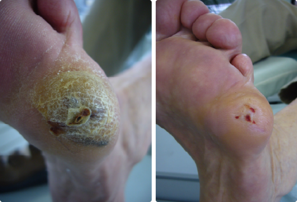 Clavus mit Hyperkeratose vorher/ nachher.