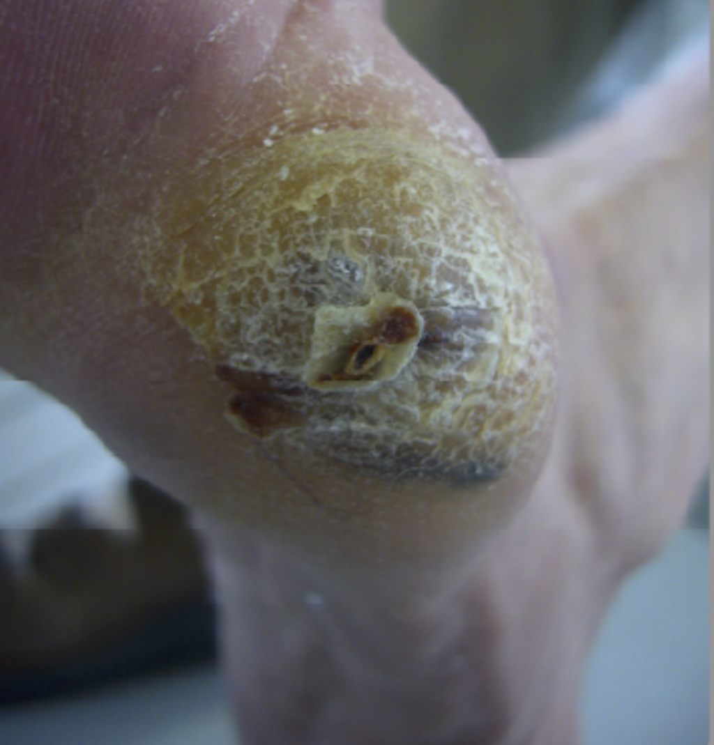 Clavus mit Hyperkeratose.