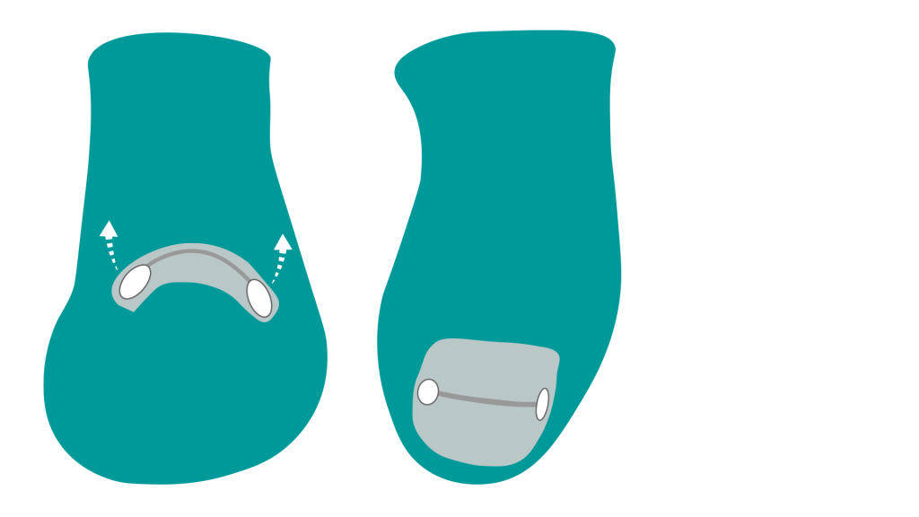 Nagelspange als Grafik.